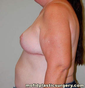 Breast Reduction Case 4474 After Photo Breast Reduction