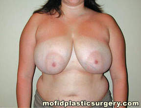 Breast Reduction Case 4490 Before Photo Breast Reduction