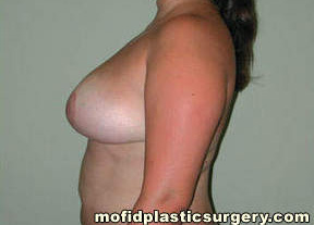Breast Reduction Case 4490 After Photo Breast Reduction