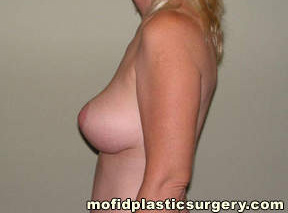 Breast Reduction Case 4506 After Photo Breast Reduction