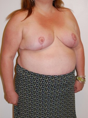 Breast Reduction Case 4532 After Photo Breast Reduction