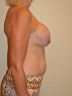 Breast Revision