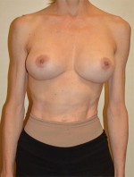 Breast Revision