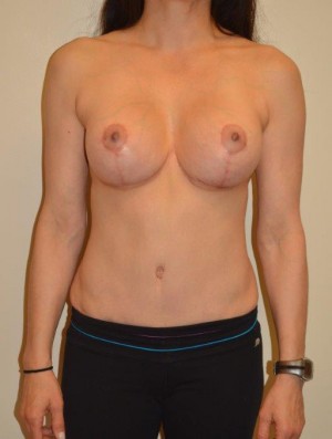 Breast Revision Case 4558 After Photo Breast Revision