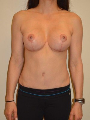 Breast Revision