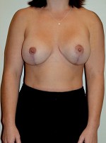 Breast Revision