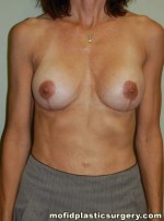 Breast Revision