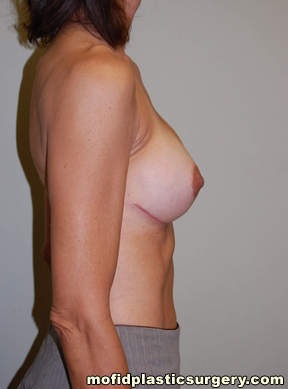 Breast Revision