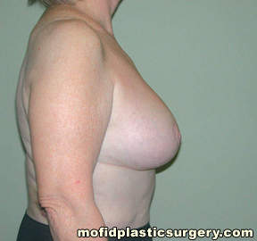 Breast Revision Case 4634 After Photo Breast Revision