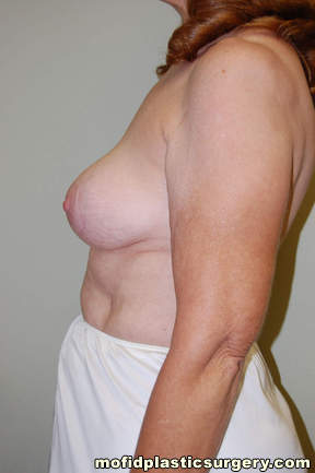 Breast Revision Case 4642 Before Photo Breast Revision
