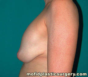 Breast Revision Case 4658 Before Photo Breast Revision