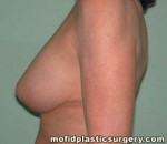 Breast Revision