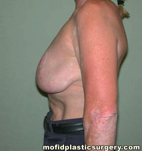 Breast Revision Case 4664 Before Photo Breast Revision