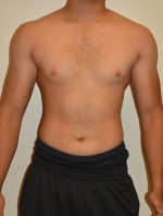 Gynecomastia