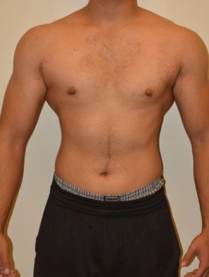 Gynecomastia