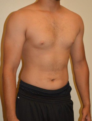 Gynecomastia Case 4680 Before Photo Gynecomastia