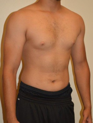 Gynecomastia