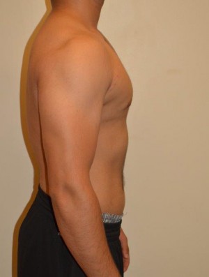 Gynecomastia Case 4680 After Photo Gynecomastia