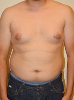 Gynecomastia