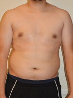 Gynecomastia