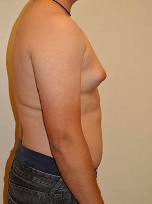 Gynecomastia