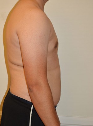 Gynecomastia