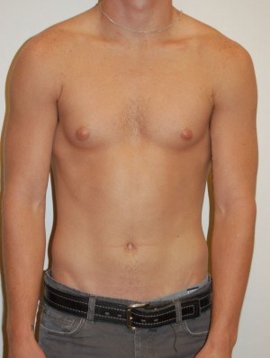 Gynecomastia Case 4696 Before Photo Gynecomastia