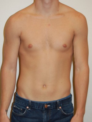 Gynecomastia Case 4696 After Photo Gynecomastia