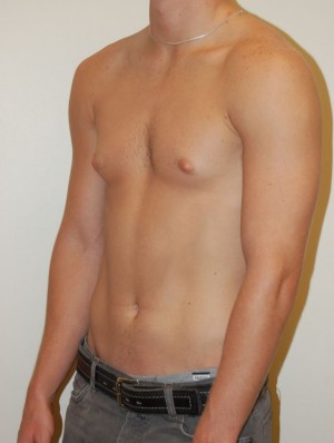 Gynecomastia Case 4696 Before Photo Gynecomastia