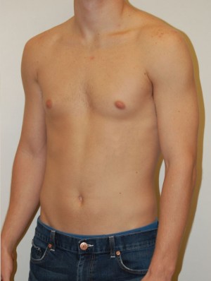 Gynecomastia