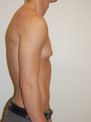Gynecomastia Case 4696 Before Photo Gynecomastia