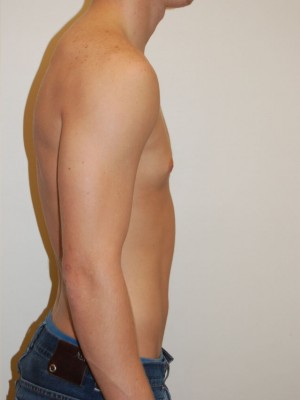 Gynecomastia Case 4696 After Photo Gynecomastia