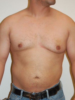 Gynecomastia Case 4704 Before Photo Gynecomastia