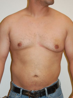 Gynecomastia