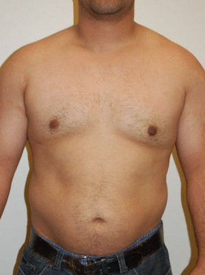 Gynecomastia Case 4704 After Photo Gynecomastia