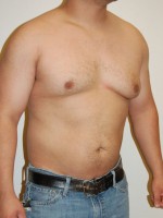 Gynecomastia