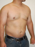 Gynecomastia