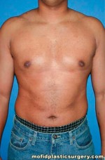 Gynecomastia