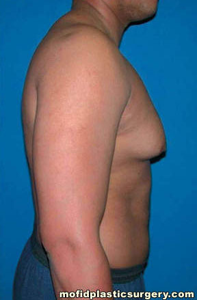 Gynecomastia