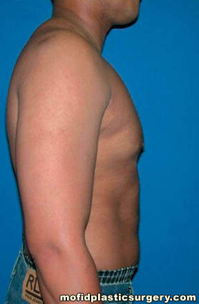 Gynecomastia