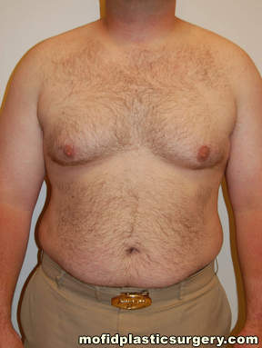 Gynecomastia