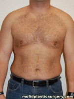 Gynecomastia