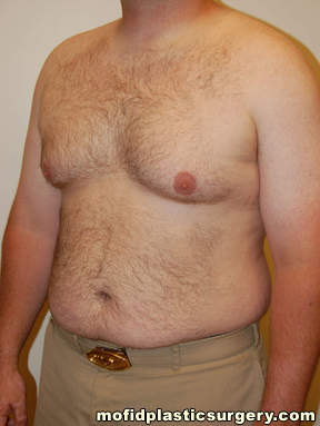 Gynecomastia