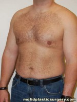 Gynecomastia