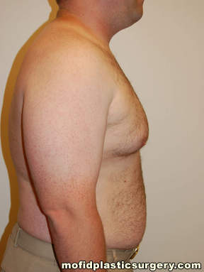 Gynecomastia