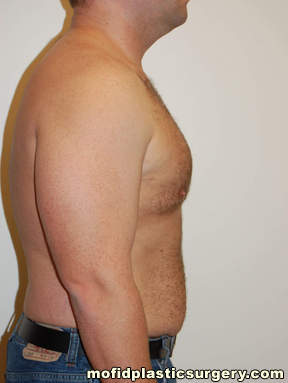 Gynecomastia