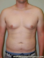 Gynecomastia