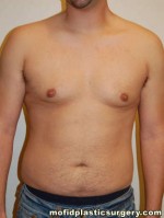 Gynecomastia