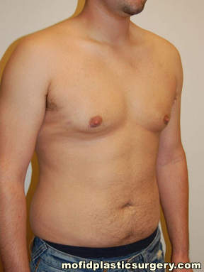 Gynecomastia