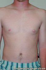 Gynecomastia